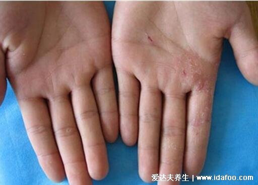 三大手癣图片初期症状，水疱型最痒/角化型最疼传染性强