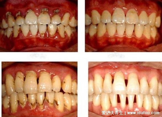 早期牙周炎圖片的癥狀表現，5大早期癥狀牙齦出血/口臭需警惕
