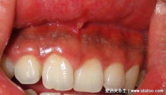 牙龈癌图片及早期三大症状，警惕溃疡和菜花样肿物的出现