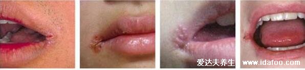 初期口角炎图片及症状，嘴角起疱会糜烂结痂(3种类型附治疗法)