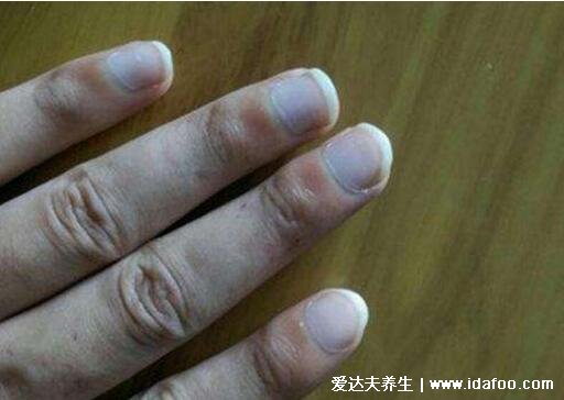 早期林赛氏指甲和正常对比图片，警惕慢性肾衰竭(多为营养不良)