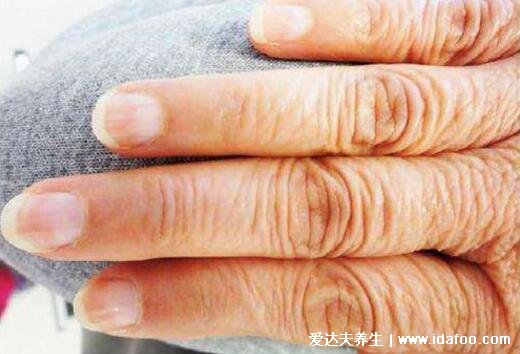 早期林赛氏指甲和正常对比图片，警惕慢性肾衰竭(多为营养不良)