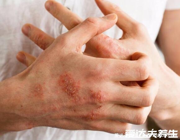 100種皮膚病對照表，警惕常見皮膚病類型(水痘/濕疹/花斑蘚/尖疣等圖)