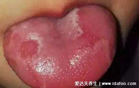 地图舌是怎么引起的图片，炎症导致舌头不规则萎缩发红(附治疗法)