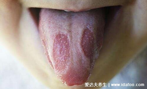 地图舌是怎么引起的图片，炎症导致舌头不规则萎缩发红(附治疗法)