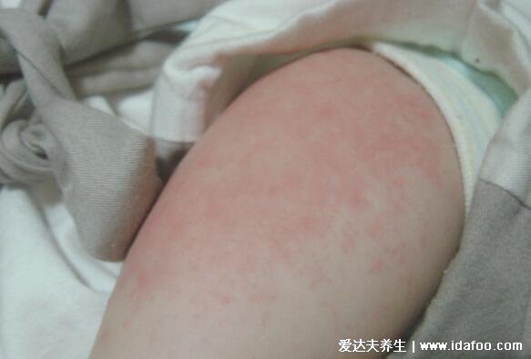 小孩第一次发烧很重要，39度高烧持续4天以上警惕幼儿急疹(家长必看)