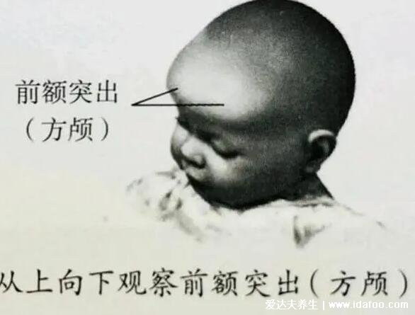 婴儿方颅图片和正常对比头型图片，上至下看前额突(正常：圆弧无棱角)