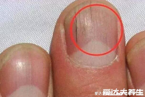 指甲有竖纹是身体的什么信号图片，指甲竖纹当心三大疾病(注意颜色)