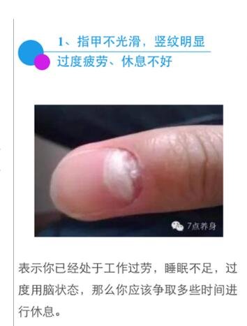 指甲有竖纹是身体的什么信号图片，指甲竖纹当心三大疾病(注意颜色)