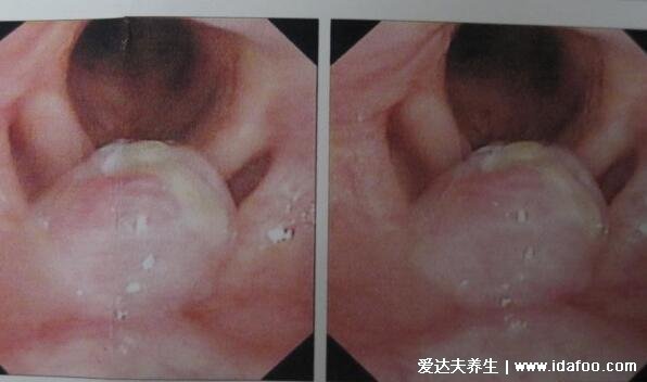 喉咙异物感一个月喉癌可能性大吗，大概率是慢性咽炎/食道炎
