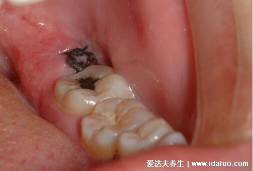 拔智齿后那个洞臭到恶心，拔牙后3-5天痛不欲生警惕干槽症