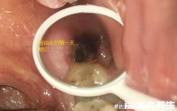 拔智齿后那个洞臭到恶心，拔牙后3-5天痛不欲生警惕干槽症