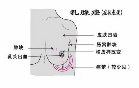 乳腺癌早期症状图片，乳房出现凹陷/乳头溢液等症状需尽快治疗