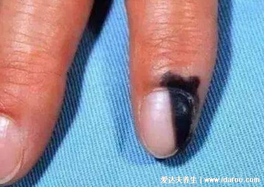 指甲竖纹多是癌症吗，可能是甲母痣(附良性以及恶性图片)