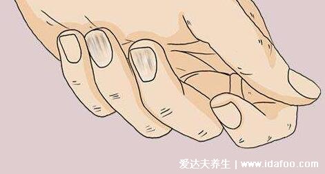 指甲竖纹多是癌症吗，可能是甲母痣(附良性以及恶性图片)