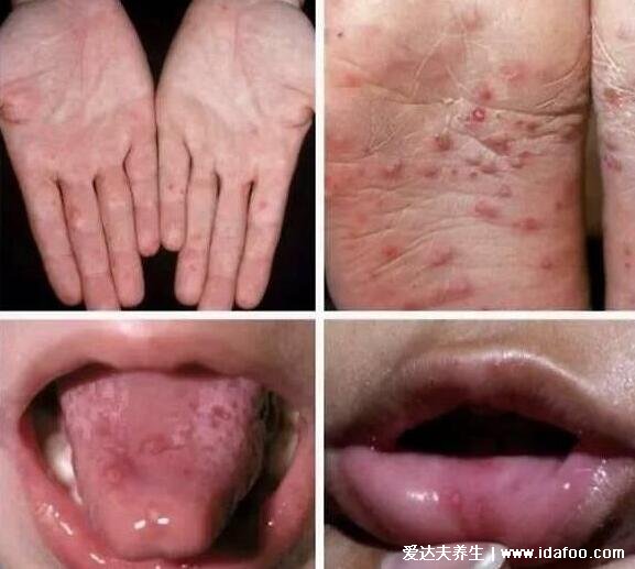 丘疹图片和症状，瘙痒或疼痛红肿的小疙瘩(众多皮肤病的症状)