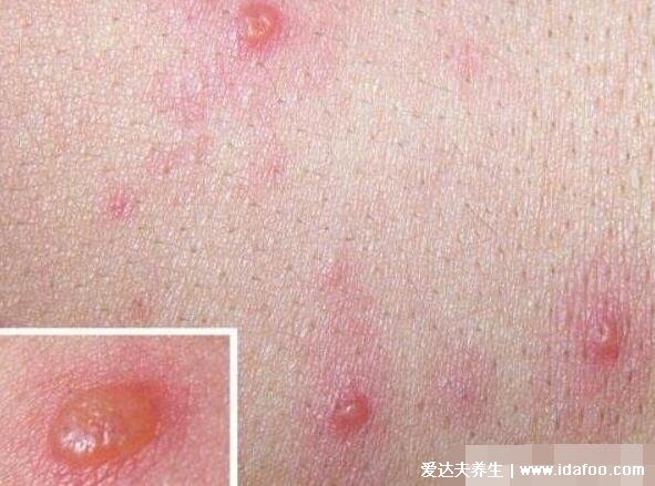 斑丘疹初期图片症状，水痘/麻疹/风疹/幼儿急疹/手足口合集