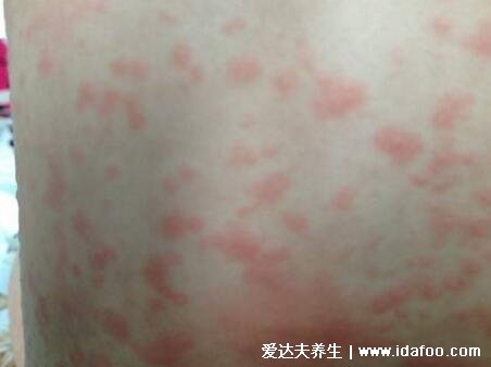 风疹图片和症状，低烧后红疹从面部蔓延至全身(5天消退)