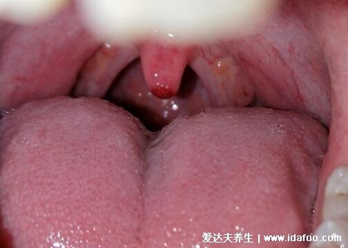 舌头上有红色的小肉粒图片，每人都有的舌乳头就是味蕾(发炎会痛)