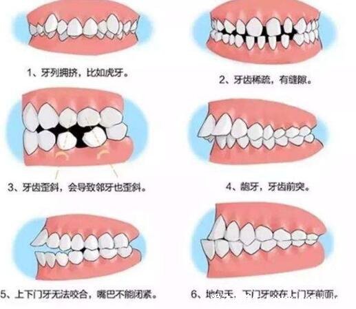 牙齿矫正最佳年龄段，12-18岁最佳可分为三个阶段(无年龄限制)