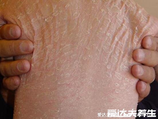 皮肤干燥脱屑像雪花图片，过热水洗澡可导致皮肤干燥症(4种可能)