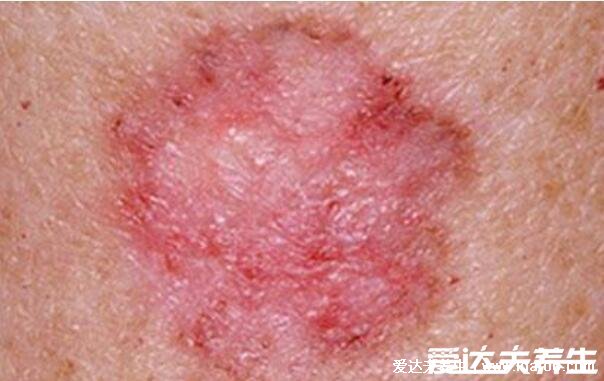 浑身瘙痒是大病的前兆，可能是这些皮肤病(附100种皮肤病对照图)