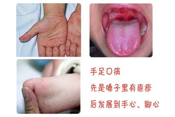 怎么判断是不是手足口病症状图片，发热后出现皮疹(附长小红点图解)