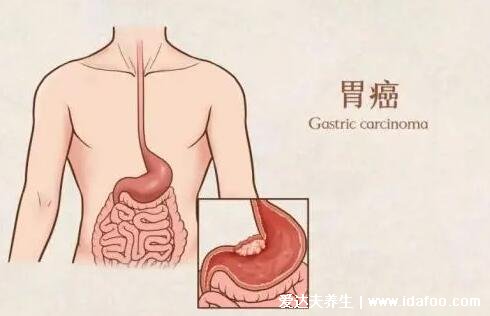 女性胃癌早期有三处痛，分别是上腹部痛/心窝痛/胃胀痛(注意吃饭情况)  