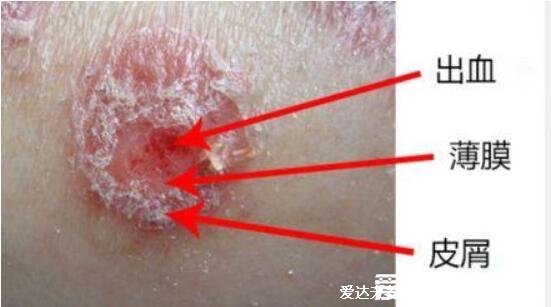 腿上起了很多红色的小点点图片，警惕湿疹/毛囊炎/银屑病等5种可能