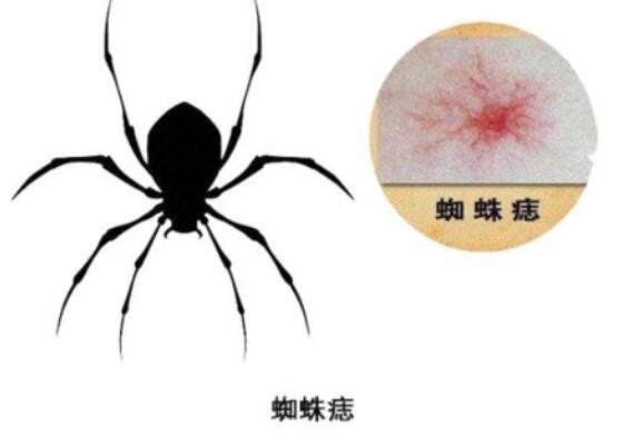 蜘蛛痣图片初期症状，可能是肝癌的早期表现(压迫后可退色)