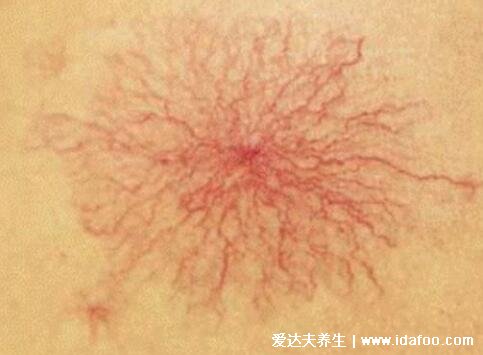 蜘蛛痣图片初期症状，可能是肝癌的早期表现(压迫后可退色)