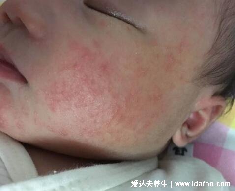 新生儿脸上有小红点图解，中毒性红斑是新生儿常见疾病(3种可能)