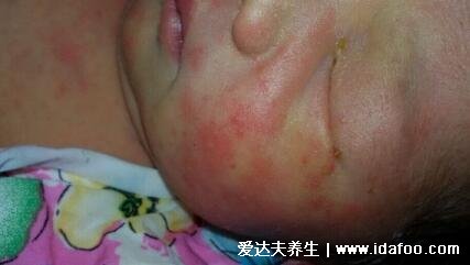 新生儿脸上有小红点图解，中毒性红斑是新生儿常见疾病(3种可能)