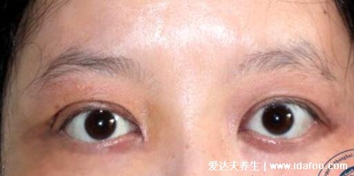 轻微早期甲亢突眼图片，甲亢眼突的六个眼征(附恢复法和饮食禁忌)