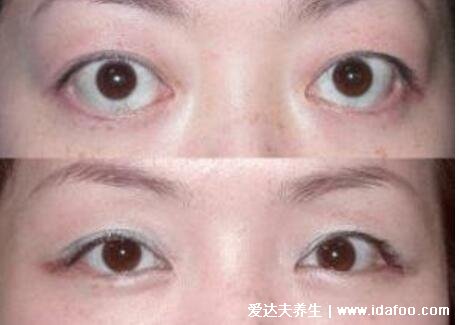 轻微早期甲亢突眼图片，甲亢眼突的六个眼征(附恢复法和饮食禁忌)