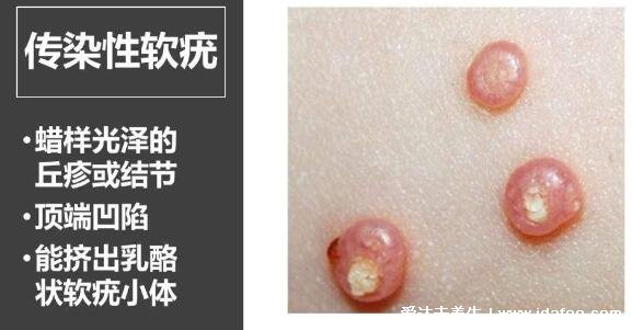 传染性软疣图片及早期症状，中央凹陷的圆形丘疹能挤出白色液体
