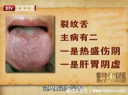 各种裂纹舌图片跟疾病的关系，裂纹舌一定得胃癌吗(5大原因)