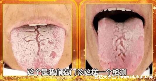 各种裂纹舌图片跟疾病的关系，裂纹舌一定得胃癌吗(5大原因)