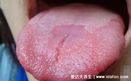 游走性舌炎图片及症状，营养不良或遗传会导致地图舌