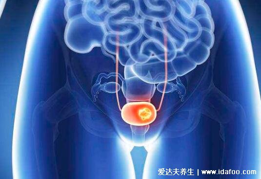 膀胱癌的早期症状图，警惕粉红色的尿液是血尿(5大前兆)