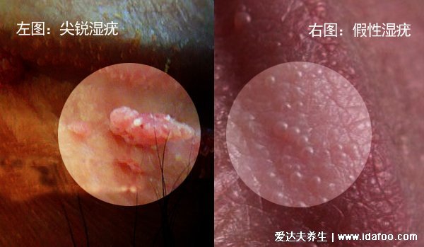 假性湿疣图片和真疣的区别图，珍珠疹和尖锐湿疣不要认错了