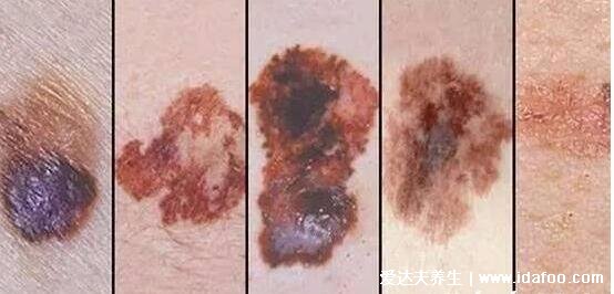 黑毛痣癌变前兆图片，警惕痣的颜色改变且会流血瘙痒疼痛