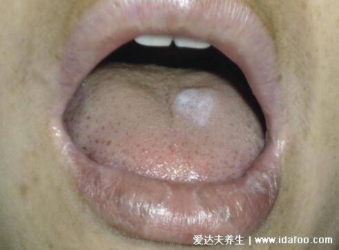 扁平苔藓图片症状，口腔长白斑/皮肤上有紫红色扁平丘疹
