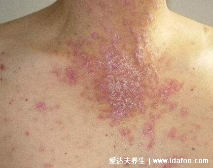 扁平苔藓图片症状，口腔长白斑/皮肤上有紫红色扁平丘疹