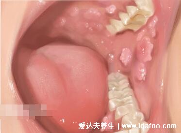 口腔尖锐湿疣图片及症状，初期舌下长米粒状小疣体(口交感染)
