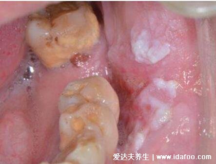 早期口腔白斑病图片，擦不掉的白色斑块是癌前病变