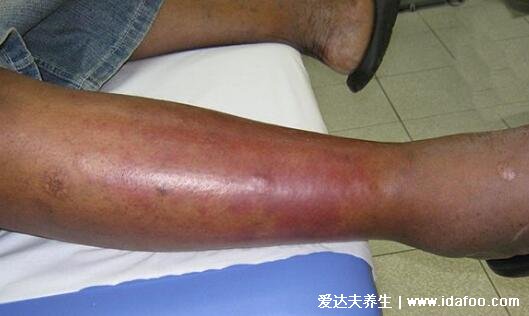 丹毒的症状图片，颜色鲜红稍微隆起的大片红肿(治疗方法)
