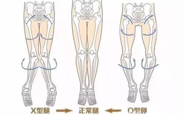 罗圈腿图片是什么样子，o型腿怎么矫正动作图