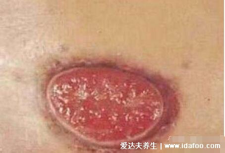 软下疳初期症状图片，生殖器的脓疱发展成痛性溃疡(X病)
