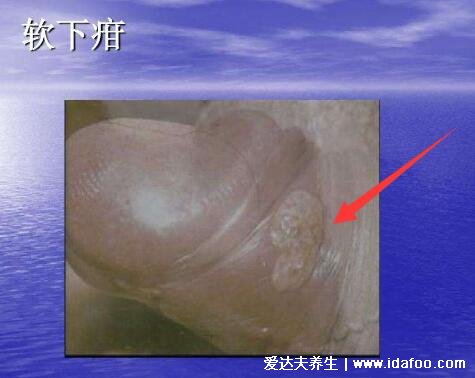 软下疳初期症状图片，生殖器的脓疱发展成痛性溃疡(X病)